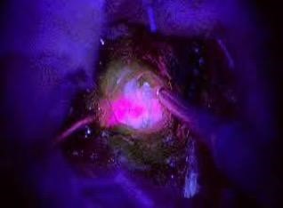 Gliomas treated with 5-ALA glow pink under ultraviolet light, helping the surgeon identify the tumour tissue to be removed